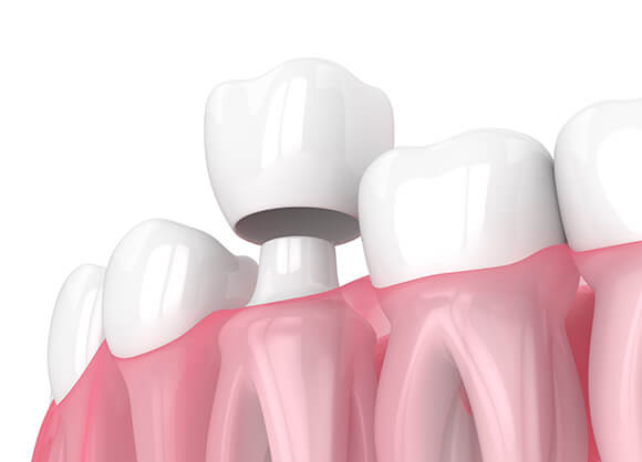 illustration of a dental crown