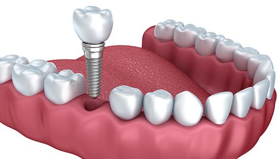 illustration of a dental implant