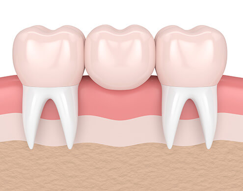 illustration of a dental bridge