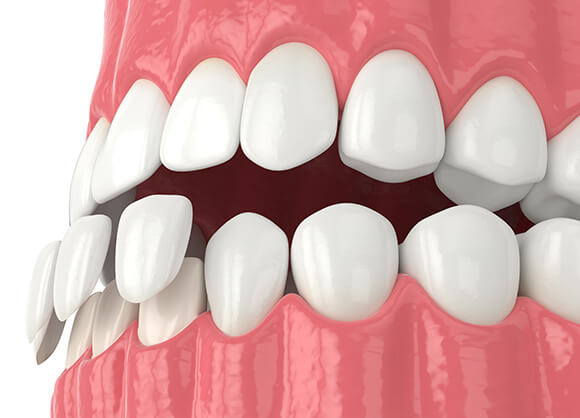 illustration of a dental veneer