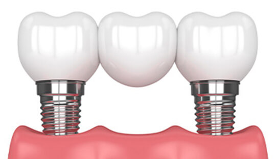 illustration of a dental bridge