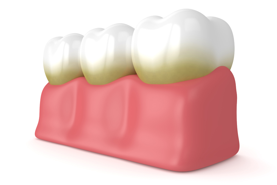 Rendering of teeth with plaque along the gumline, which must be removed with daily brushing and routine dental cleanings