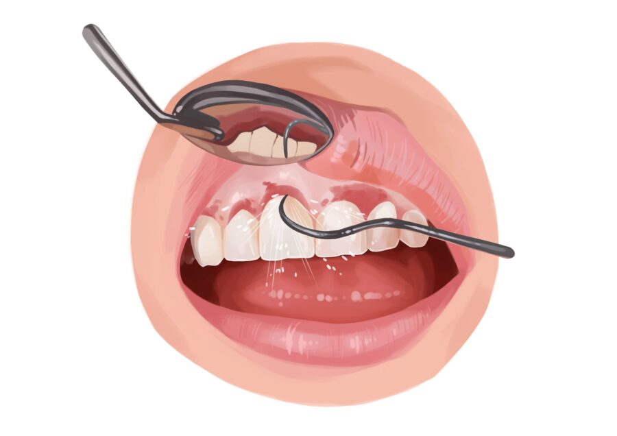 Image of scaling and root planing for irritated & inflamed gums