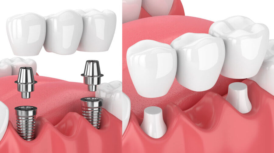 A side-by-side dental bridge, one with dental implants and one on top of natural teeth