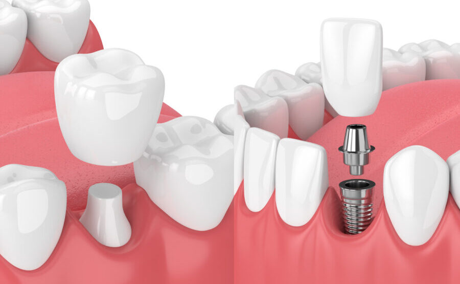 A side-by-side of a dental crown topping a natural tooth and completing a dental implant