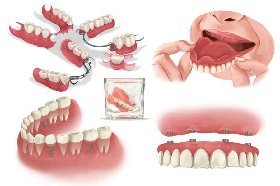 Illustrations of different configurations of dentures to replace missing teeth