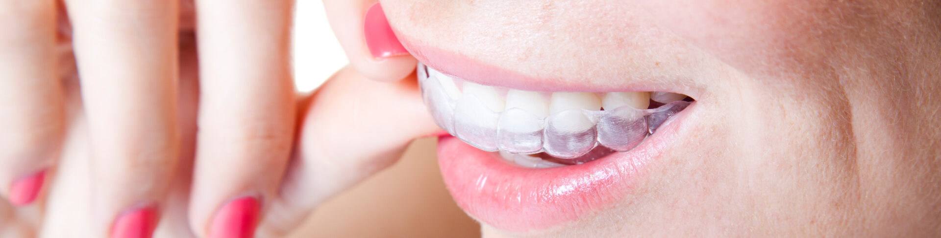 SureSmile® Clear Aligner Therapy
