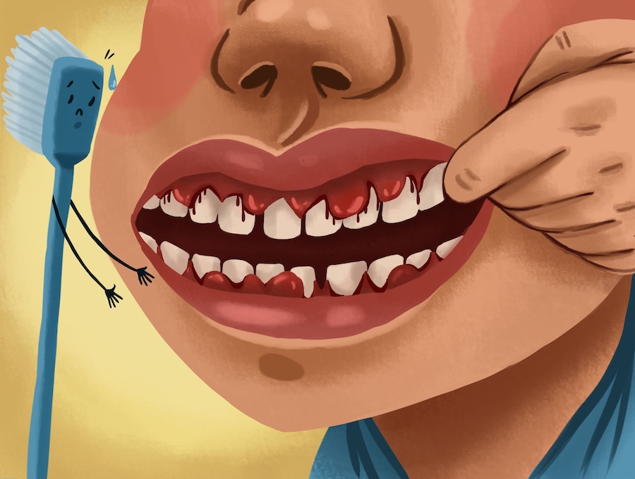 man with bleeding gums, gingivitis treatment