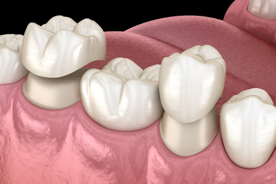 same-day dental crown, CEREC
